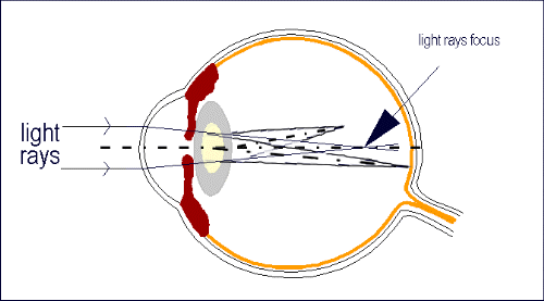 astigmatism (from:Cornea Genetic Eye Institute)