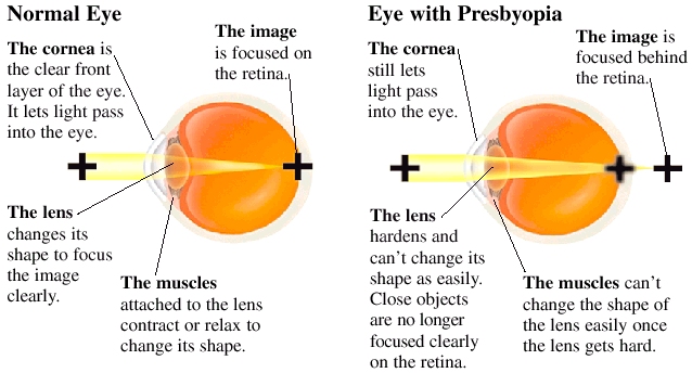 presbyopia (form: www.healthline.com)