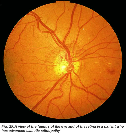 diabetic retinopathy (from: Utah University)
