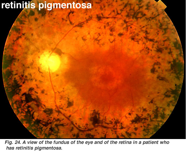 retinitis pigmentosa (from: Utah University)