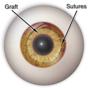 penetrating keratoplasty (from: www.center-for-sight.com)